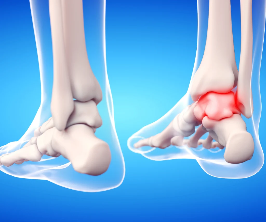 Diagram of an ankle before arthroscopy
