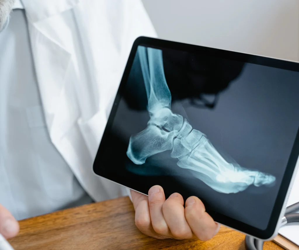 XRay of Ankle before Brostrom Operation