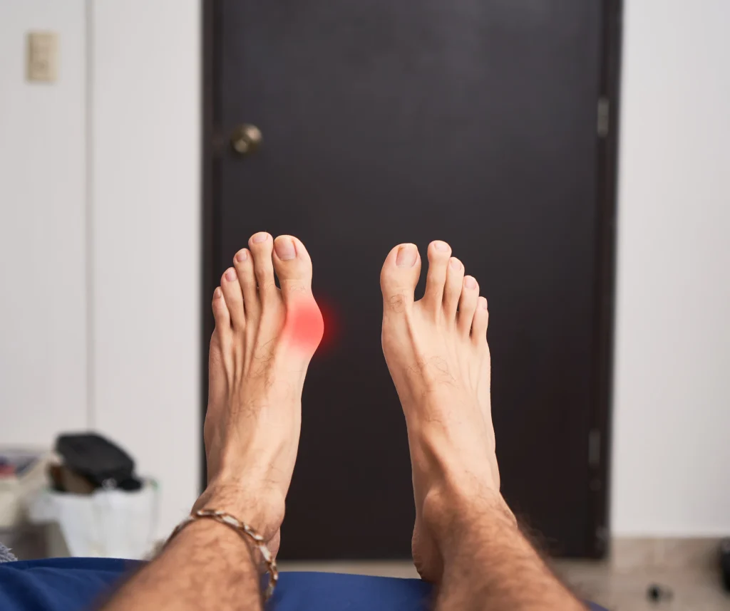 Image of feet before Cheilectomy
