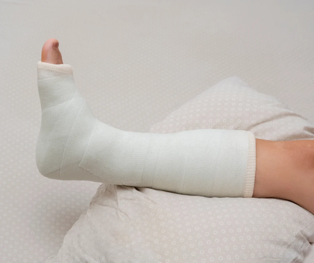 Lower leg in a cast