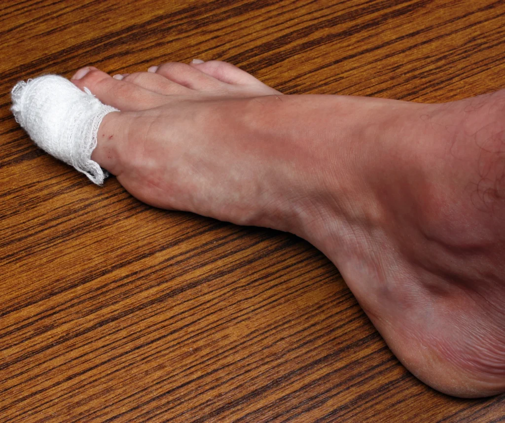 Big toe with stiffness wrapped in gauze