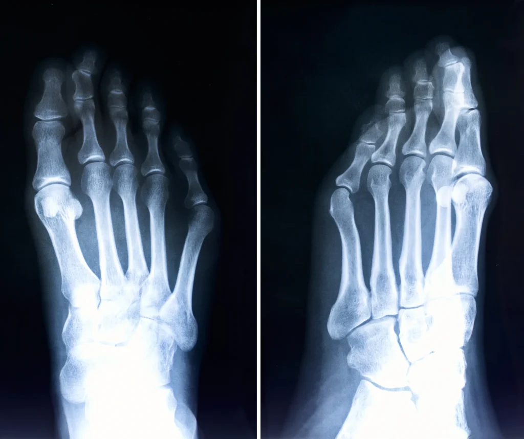 XRay of a foot that needs forefoot reconstruction