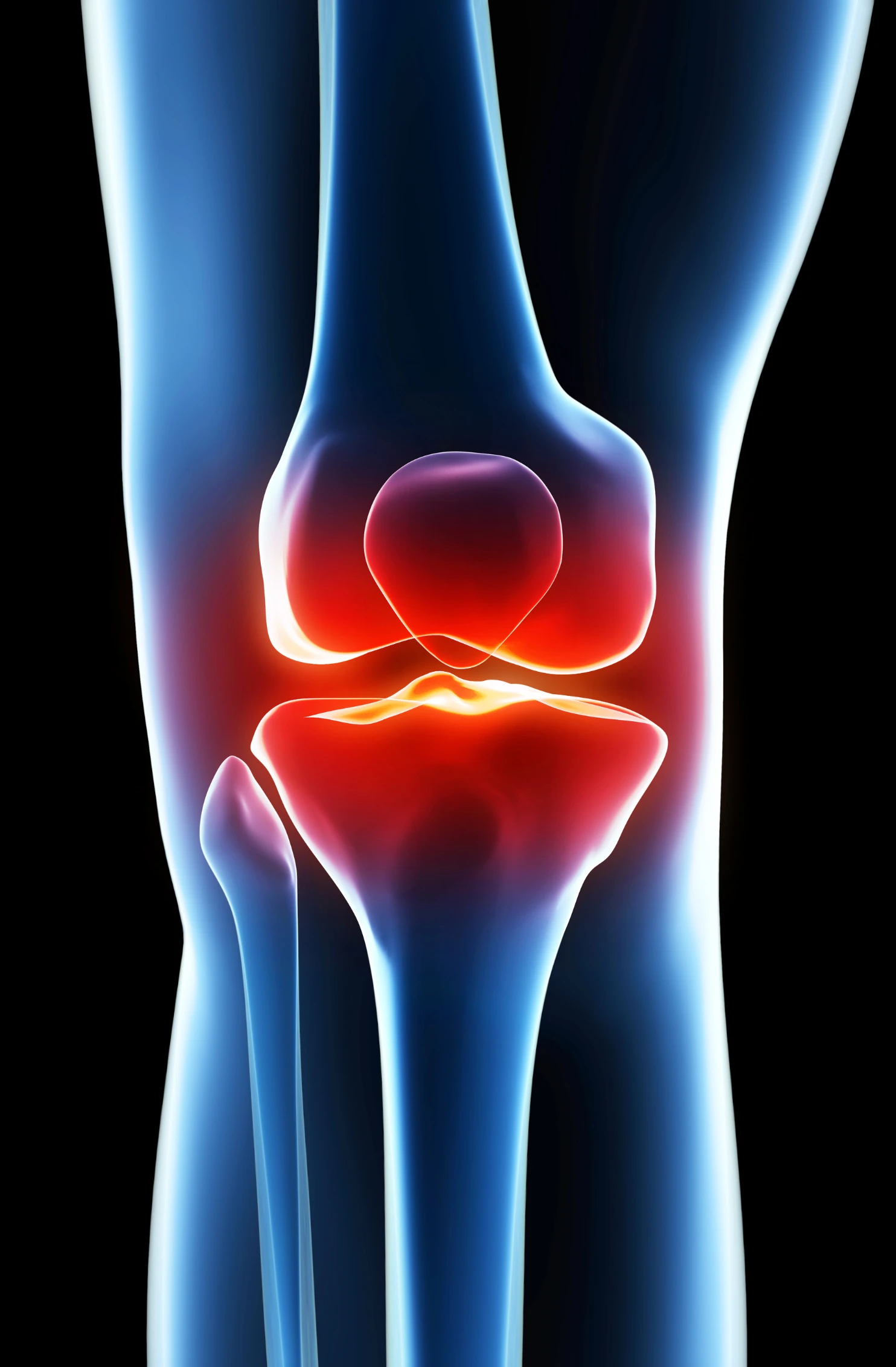 Diagram of Knee instability