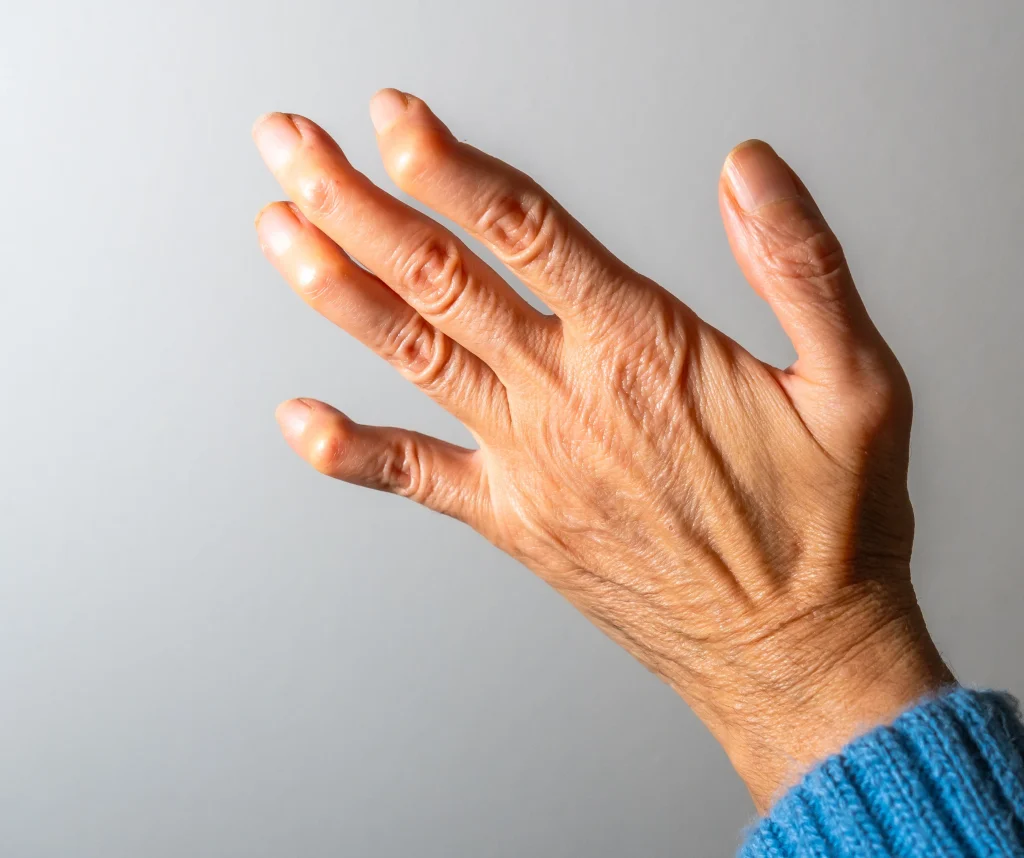 Finger Deformities