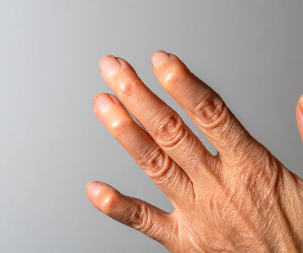 Hand deformities