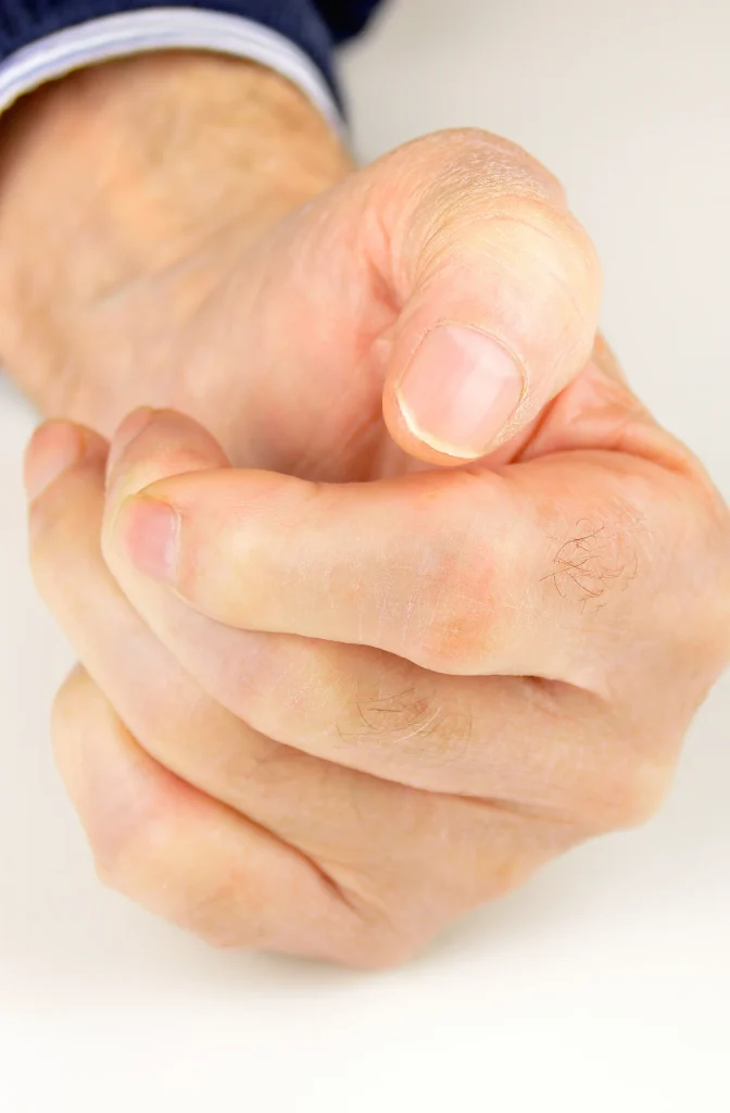 Hand with Dupytrens