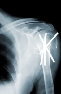 XRay of shoulder with pins in