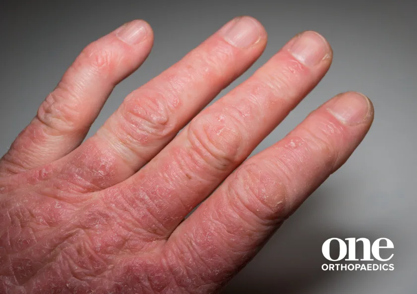 Close up of a hand with finger deformities