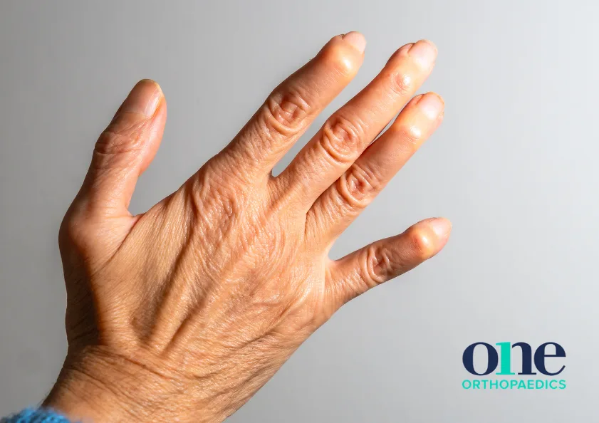 You are currently viewing What Are Finger Deformities and What Causes Them?